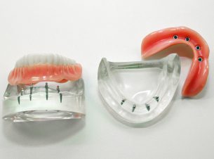 Zahnarztpraxis Stefan Hoffmann - Miniimplantate Unterkiefer